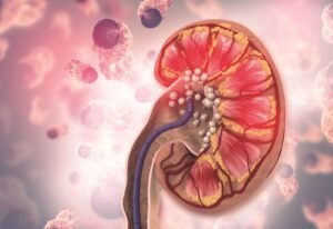 Kenali Gejala Batu Ginjal dan Cara Pengobatannya Menurut Dokter