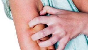 Sering Tertukar, Ini Perbedaan Kusta dan Kista