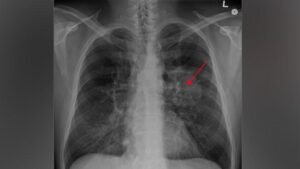 Tanda Aneh Ini Bisa Sinyal Kanker Paru